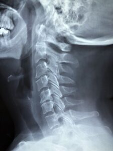spinal fractures