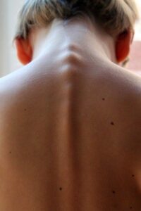 living with scoliosis
