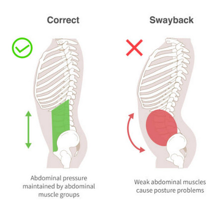 swayback lordosis