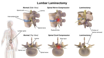 lumbar laminectomy